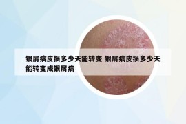 银屑病皮损多少天能转变 银屑病皮损多少天能转变成银屑病