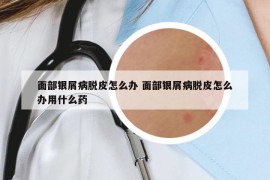 面部银屑病脱皮怎么办 面部银屑病脱皮怎么办用什么药
