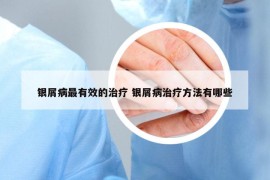 银屑病最有效的治疗 银屑病治疗方法有哪些