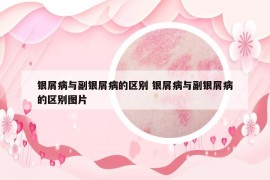 银屑病与副银屑病的区别 银屑病与副银屑病的区别图片