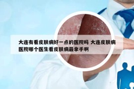 大连有看皮肤病好一点的医院吗 大连皮肤病医院哪个医生看皮肤病最拿手啊