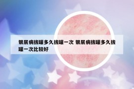 银屑病拔罐多久拔罐一次 银屑病拔罐多久拔罐一次比较好