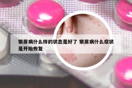 银屑病什么样的状态是好了 银屑病什么症状是开始恢复