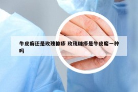 牛皮癣还是玫瑰糠疹 玫瑰糠疹是牛皮廨一种吗