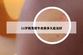 11岁刚发现牛皮癣多久能治好