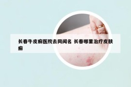 长春牛皮癣医院去同闻名 长春哪里治疗皮肤癣
