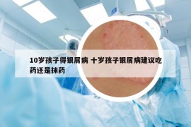 10岁孩子得银屑病 十岁孩子银屑病建议吃药还是抹药