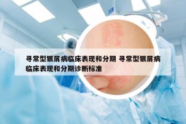 寻常型银屑病临床表现和分期 寻常型银屑病临床表现和分期诊断标准