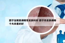 西宁治银屑病哪家皮肤科好 西宁市皮肤病哪个大夫看的好