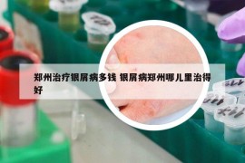 郑州治疗银屑病多钱 银屑病郑州哪儿里治得好