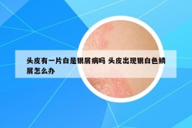 头皮有一片白是银屑病吗 头皮出现银白色鳞屑怎么办