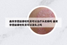 曲安奈德益康唑乳膏可以治疗头皮癣吗 曲安奈德益康唑乳膏可以涂头上吗