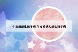牛皮癣能生孩子吧 牛皮癣病人能生孩子吗