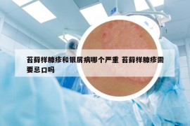 苔藓样糠疹和银屑病哪个严重 苔藓样糠疹需要忌口吗