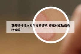 夏天喝柠檬水对牛皮癣好吗 柠檬对皮肤病有疗效吗