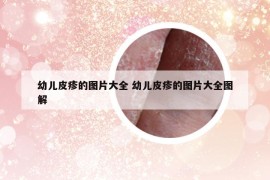 幼儿皮疹的图片大全 幼儿皮疹的图片大全图解