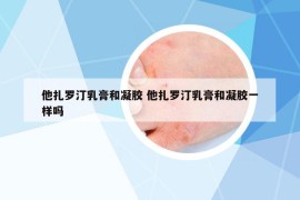他扎罗汀乳膏和凝胶 他扎罗汀乳膏和凝胶一样吗