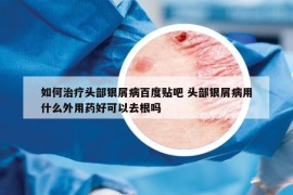 如何治疗头部银屑病百度贴吧 头部银屑病用什么外用药好可以去根吗