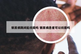 银屑病期间能纹眉吗 银屑病患者可以纹眉吗