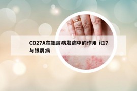 CD27A在银屑病发病中的作用 il17与银屑病