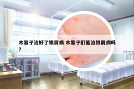 木鳖子治好了银屑病 木鳖子酊能治银屑病吗?