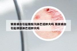 银屑病会引起腹股沟淋巴结肿大吗 银屑病会引起颈部淋巴结肿大吗