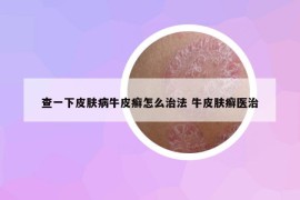 查一下皮肤病牛皮癣怎么治法 牛皮肤癣医治