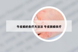 牛皮癣的食疗方法法 牛皮肤癣食疗