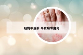 硅霜牛皮癣 牛皮癣专用膏