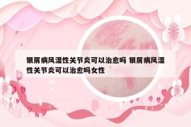 银屑病风湿性关节炎可以治愈吗 银屑病风湿性关节炎可以治愈吗女性