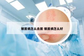 银屑病怎么去屑 银屑病怎么好