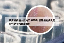 银屑病的病人能吃竹笋干吗 银屑病的病人能吃竹笋干吗百度百科