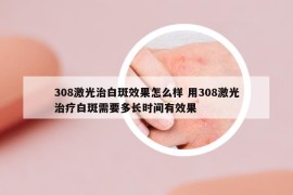 308激光治白斑效果怎么样 用308激光治疗白斑需要多长时间有效果