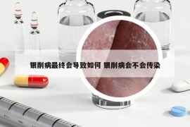 银削病最终会导致如何 银削病会不会传染