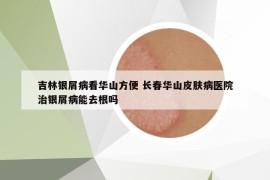 吉林银屑病看华山方便 长春华山皮肤病医院治银屑病能去根吗