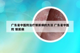 广东省中医院治疗银屑病的方法 广东省中医院 银屑病