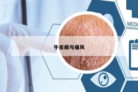 牛皮癣与痛风