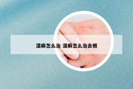 湿癣怎么治 湿癣怎么治去根