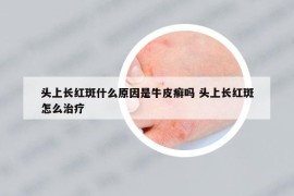 头上长红斑什么原因是牛皮癣吗 头上长红斑怎么治疗