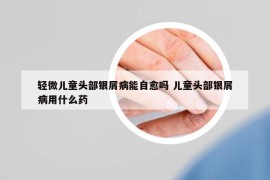 轻微儿童头部银屑病能自愈吗 儿童头部银屑病用什么药