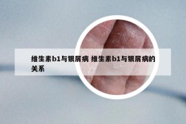 维生素b1与银屑病 维生素b1与银屑病的关系