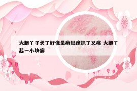 大腿丫子长了好像是癣很痒抓了又痛 大腿丫起一小块癣