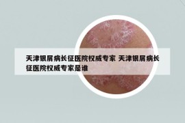 天津银屑病长征医院权威专家 天津银屑病长征医院权威专家是谁