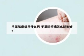 手掌脓疱病用什么药 手掌脓疱病怎么能治好?