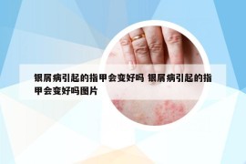 银屑病引起的指甲会变好吗 银屑病引起的指甲会变好吗图片