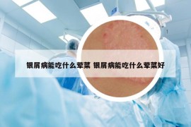 银屑病能吃什么荤菜 银屑病能吃什么荤菜好