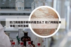 肛门周围像干癣似的是怎么了 肛门周围起来像癣一样的发痒