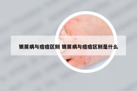 银屑病与痘痘区别 银屑病与痘痘区别是什么