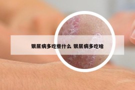 银屑病多吃些什么 银屑病多吃啥
