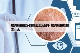 银屑病抽很多的血是怎么回事 银屑病抽血检查什么
